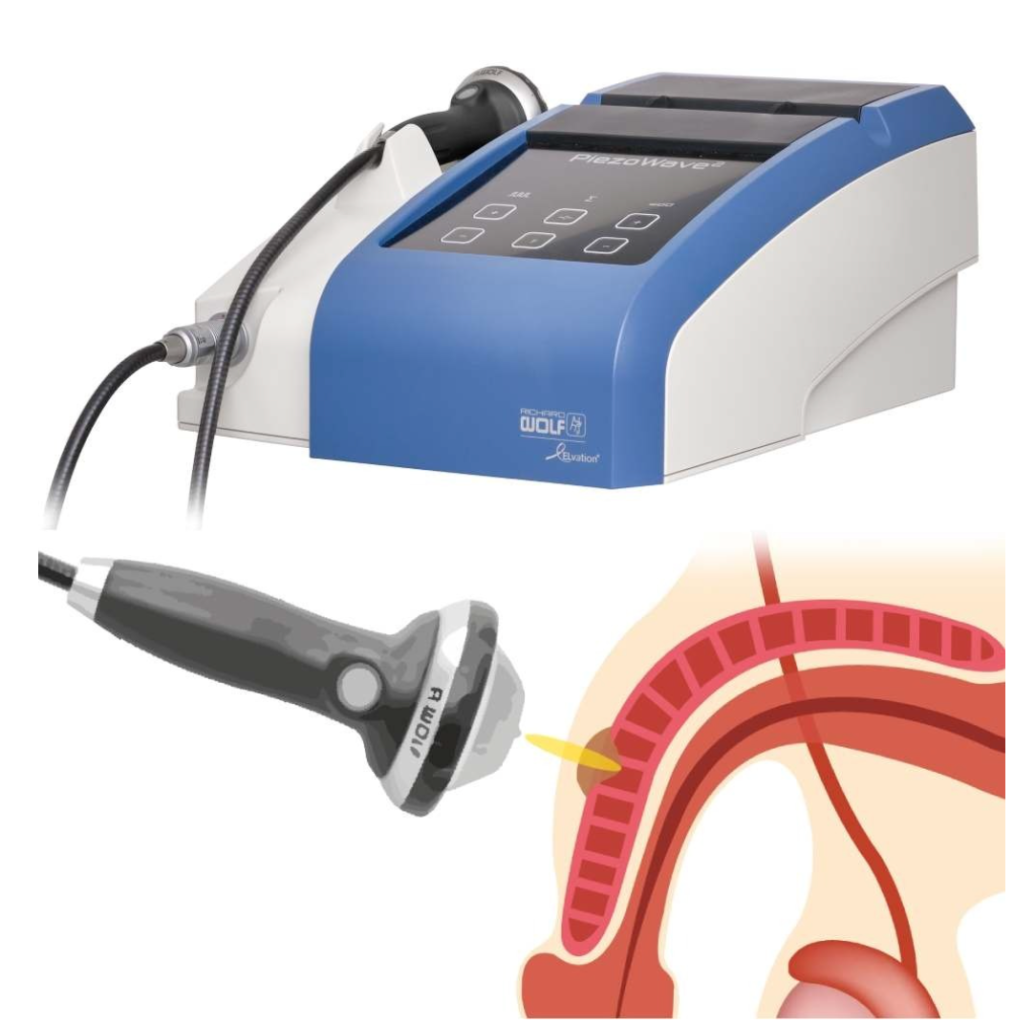 LISWT - ondas de choque para peyronie
