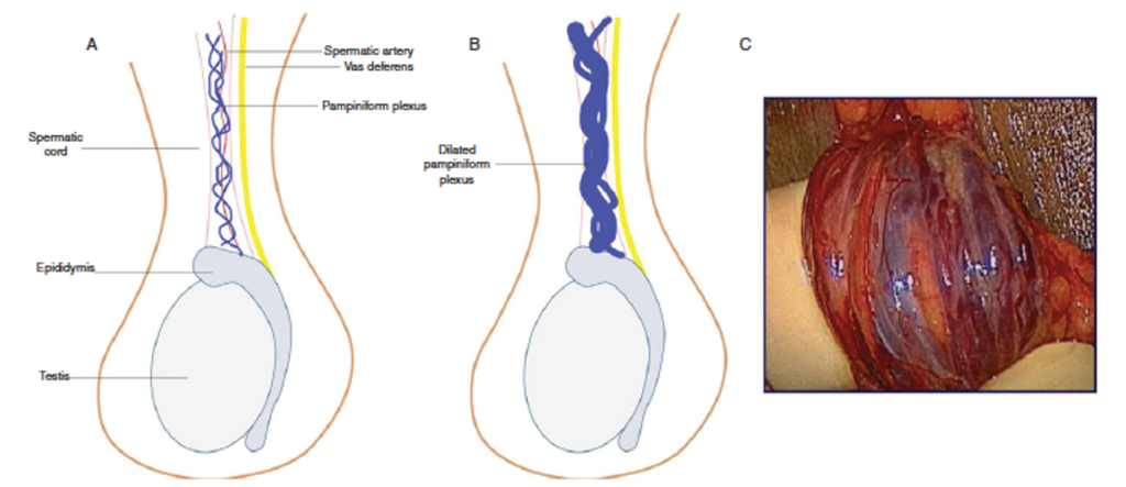 varicocele e cirrugia de varicocele