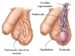 varicocele grau iii