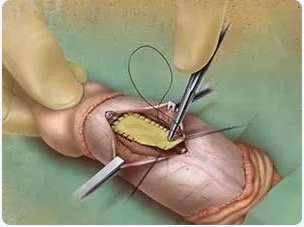 Cirurgia para tratamento de doença de Peyronie